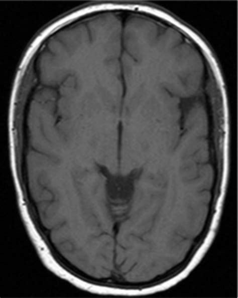 Gadolinium Accumulation Questions And Answers In Mri