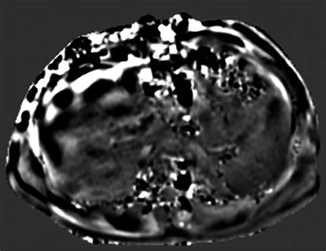 Mr Elastography Spleen Stiffness Measurements In Healthy Volunteers