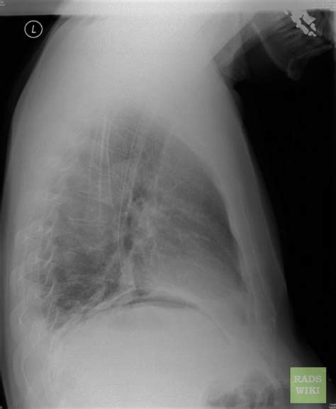 Pneumoperitoneum Wikidoc