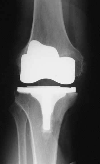 Knee Replacement X-Ray After Orthopedic Surgery