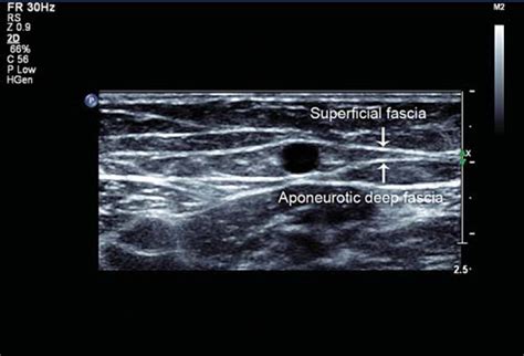 Long Saphenous Vein And Its Anatomical Variations Chen 2009