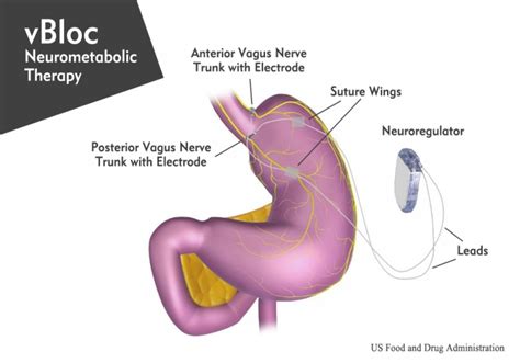 Should Vbloc Neurometabolic Therapy Ever Be Performed Obesity Help