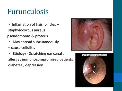 External Ear Cellulitis