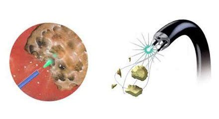 Urology Laser For Lithotripsy | Potent Medical