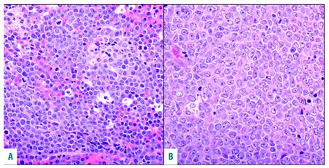 Inferior Survival In High Grade B Cell Lymphoma With Myc And Bcl2 Andor Bcl6 Rearrangements Is