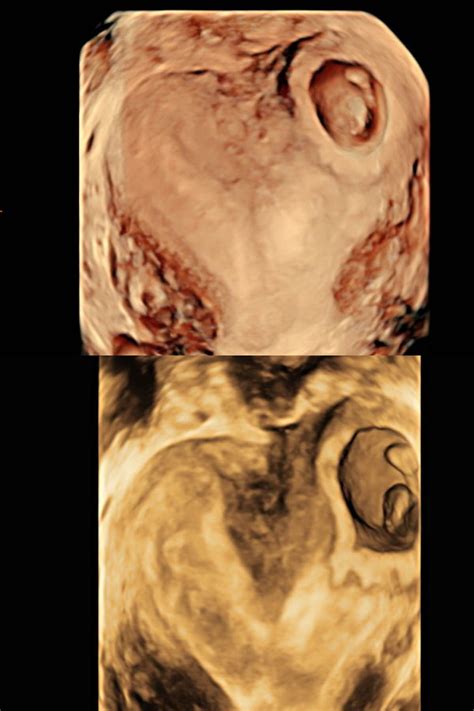 Bicornuate Uterus With Pregnancy TVS Ultrasound Pelvis Viability