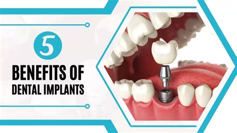 Ppt Benefits Of Dental Implants Powerpoint Presentation Free