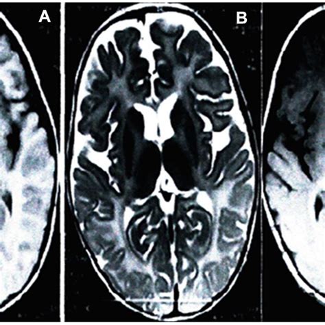 Brain MRI Of The Proband Scans Showed Significantly Development Delay