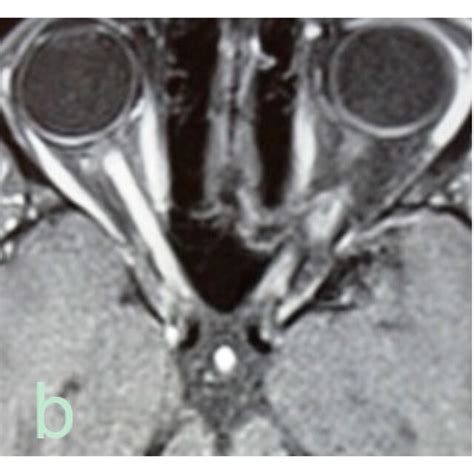 Optic Nerve Abnormalities On Mri In Aqp4 Seropositive Nmosd Patients Download Scientific