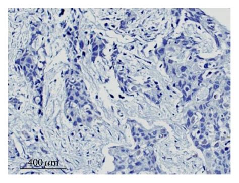 ERβ1 expression in archival TNBC specimens. Representative examples are... | Download Scientific ...