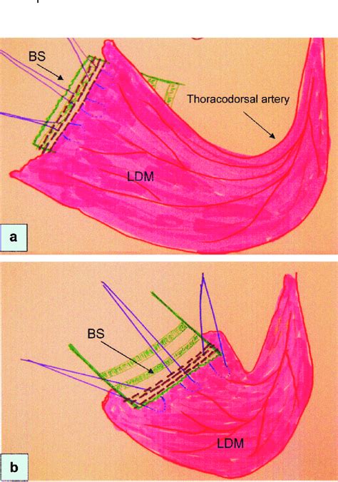 The Latissimus Dorsi Muscle Flap A Fixation From Behind With Pds Ii