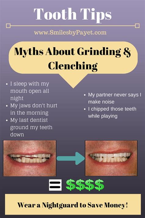 Teeth Grinding Bruxism Dental Nightguard Dentist Charlotte Nc