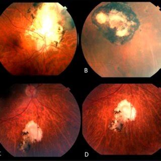 Pdf Toxoplasmic Retinochoroiditis Caused By Toxoplasma Gondii Strain