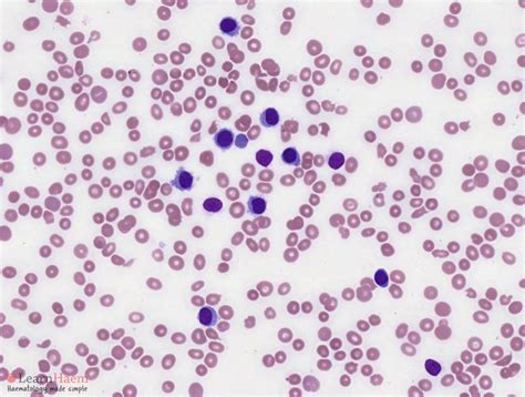 Hairy Cell Leukaemia Learnhaem Haematology Made Simple