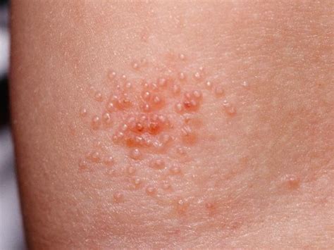 Molluscum Contagiosum Dermatology Surgery Center Niceville Fl