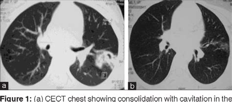 Figure 1 From Retropharyngeal Abscess As A Rare Presentation Of