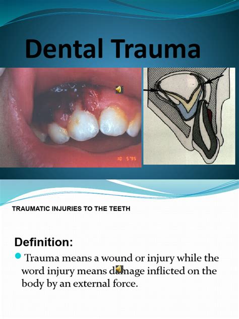 Dental Trauma | PDF