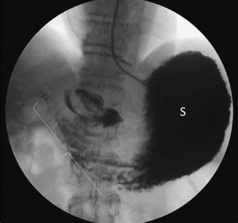 Gastric Outlet Obstruction Anesthesia Key