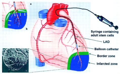 Repair Of Infarcted Myocardium By Autologous Intracoronary Mononuclear