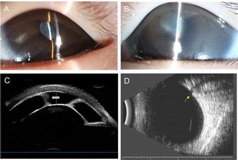 Anterior Segment Photography Ultrasound Biomicroscopy Ubm And