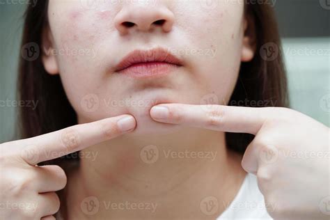 Grano De Acn Y Cicatriz En La Cara De La Piel Trastornos De Las