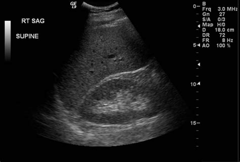 Normal Liver Echotexture on Ultrasound - radRounds Radiology Network