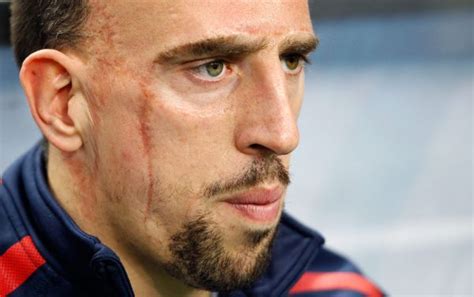 Lloraba A Escondidas La Dramática Infancia De Ribery Y La Historia De Su Cicatriz De Cien Puntos