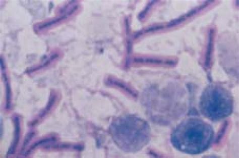 Bacillus Anthracis