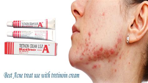 How Much Time the Tretinoin Cream takes to shows it’s Results – Cosmetics and you : Acne ...