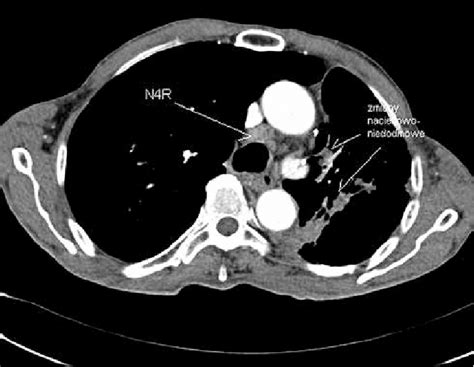 Mediastinal Lymph Nodes CT Scan