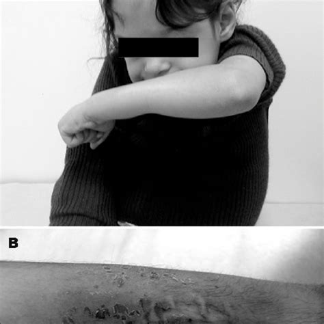 Congenital bilateral clubfoot. | Download Scientific Diagram