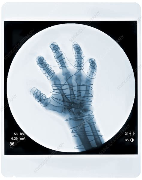 Hand Fluoroscope Stock Image C0047424 Science Photo Library