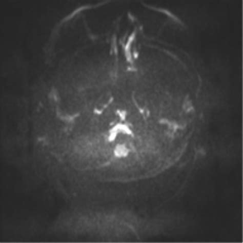 Clival Chordoma Invading The Hypoglossal Canal Image Radiopaedia Org