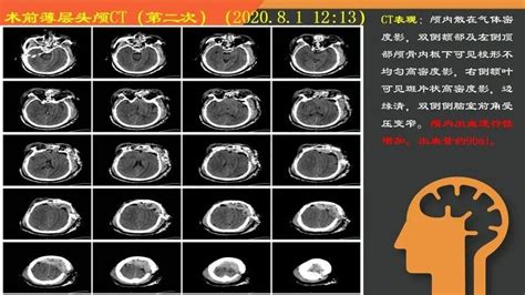 复杂重型开放性颅脑损伤一例 脑医汇 神外资讯 神介资讯