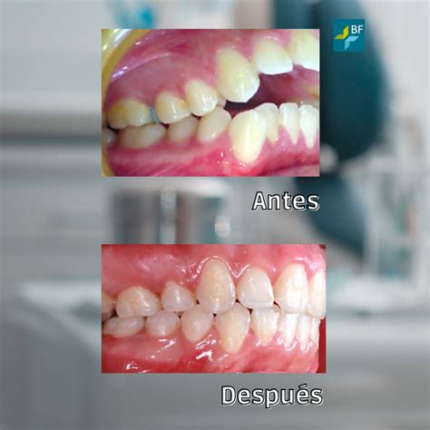 Mordida Abierta Clase Ii Centro Odontol Gico Bf Est Tica Dental