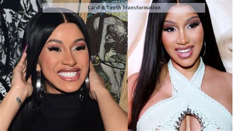 Cardi B Teeth Transformation: Before And After Facts