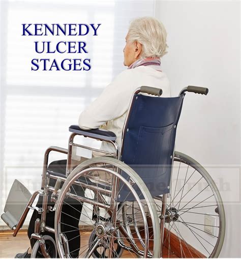 Kennedy Ulcer Stages - Bed Sores End of Life *(2023 Update)*