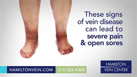 Itchy Ankles Leg Rashes Or Dry Skin You Could Have Underlying Vein