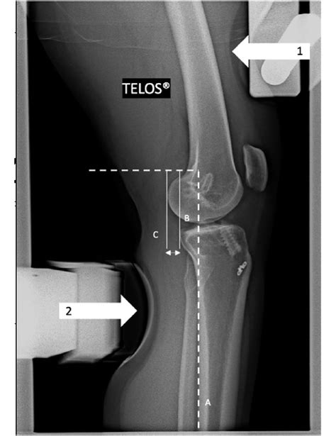 Lateral Right Knee Radiograph Demonstrating Dynamic Anterior Tibial