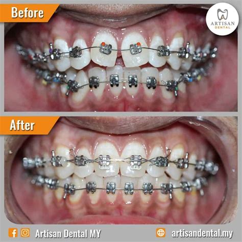 Self-Ligating Braces - Artisan Dental