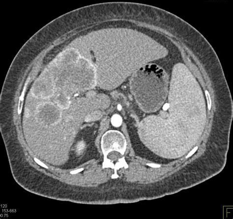 Intrahepatic Cholangiocarcinoma - Liver Case Studies - CTisus CT Scanning