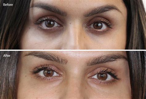 Laser Treatments For Dark Circles Are They Worth It Before And Afters Cost