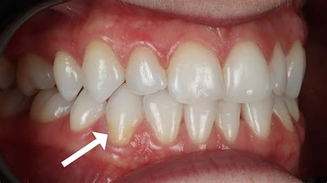 Gum Recession Root Exposure What Caused It And Treatments