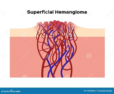 Hemangioma Diagram