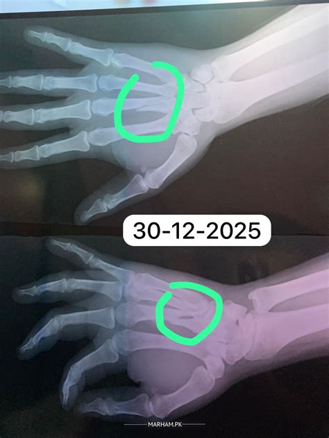 Ask a Orthopedic Surgeon Online for Bone Fractured (Metacarpal) Not Healing