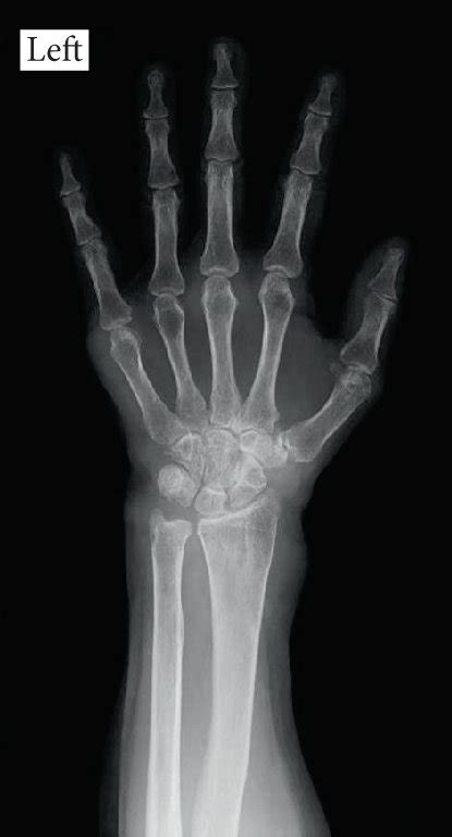 Anterior Posterior Plain Radiographs Showing Bone Atrophy Around The