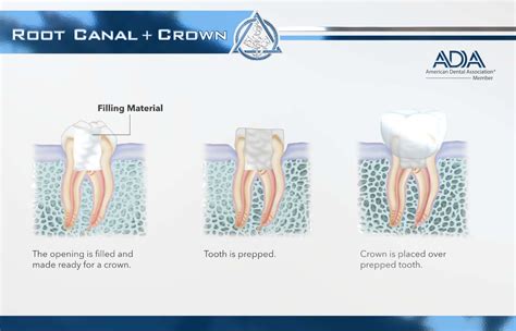 Root Canal & Crown — Viva Concepts