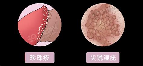 丁丁長了“珍珠疹”，怎么辦？哪些藥物能治好？建議男人都看看