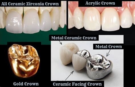 Cost of Dental Crowns in India, Cost of Crowns in India