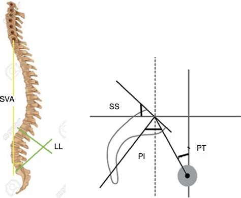 Scielo Brasil Toracolombar Burst Fractures And Spinopelvic Balance Toracolombar Burst